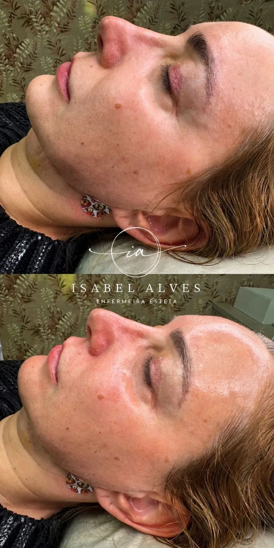 Pele da paciente antes e depois da recuperação da barreira cutânea, mais equilibrada, viçosa e com brilho natural.