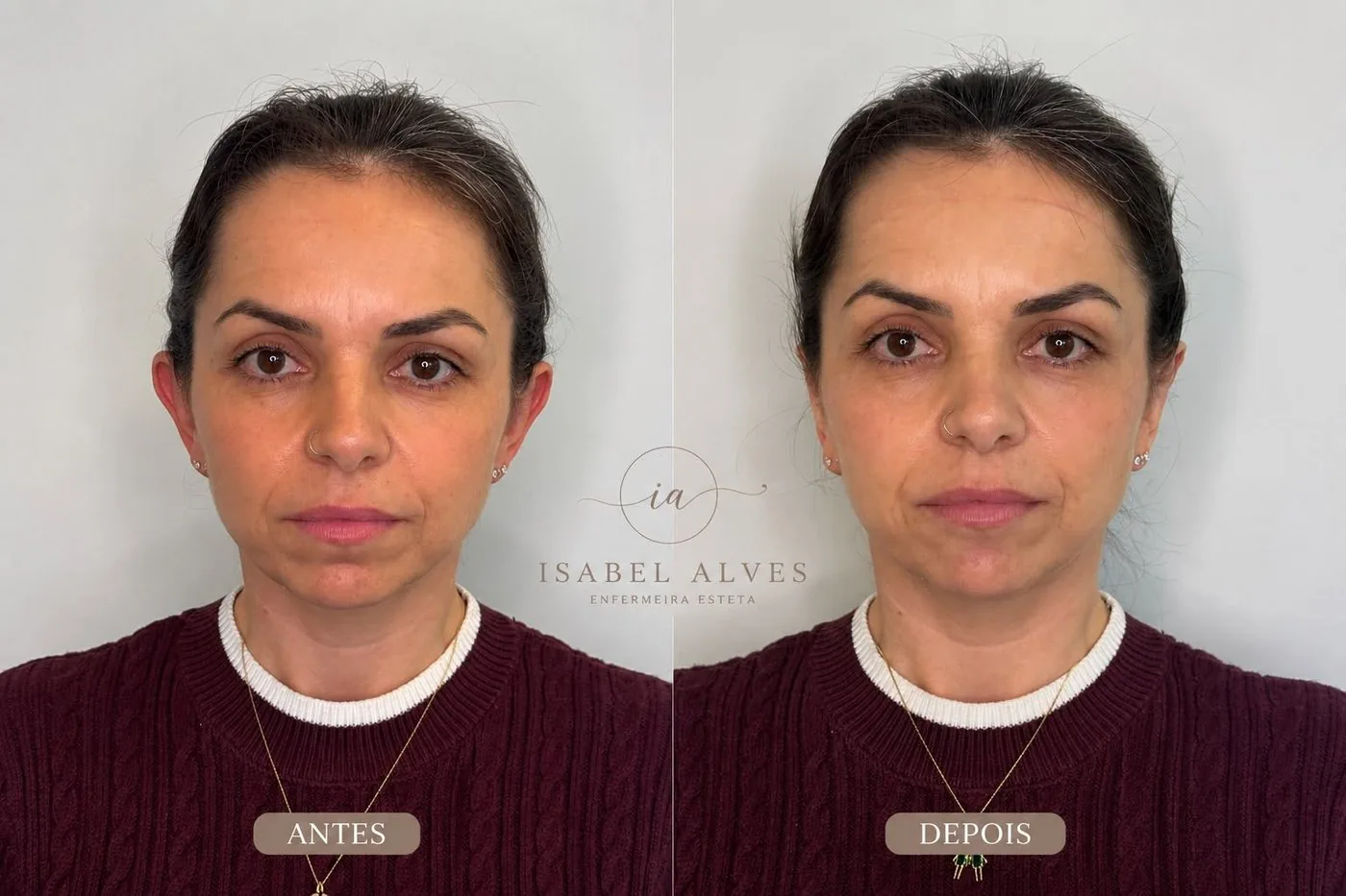 Paciente antes e depois da otomodelação: no antes as orelhas se projetam para fora, no depois ficam rentes à cabeça.