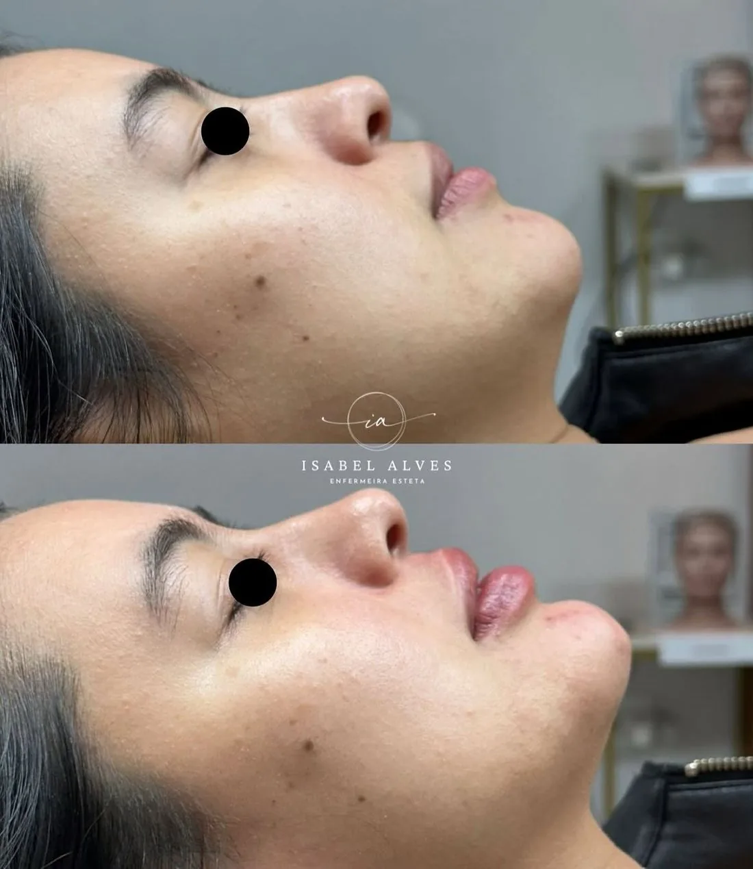 Perfil da paciente antes e depois da perfiloplastia, com lábios e mento mais projetados e o contorno do queixo mais definido.