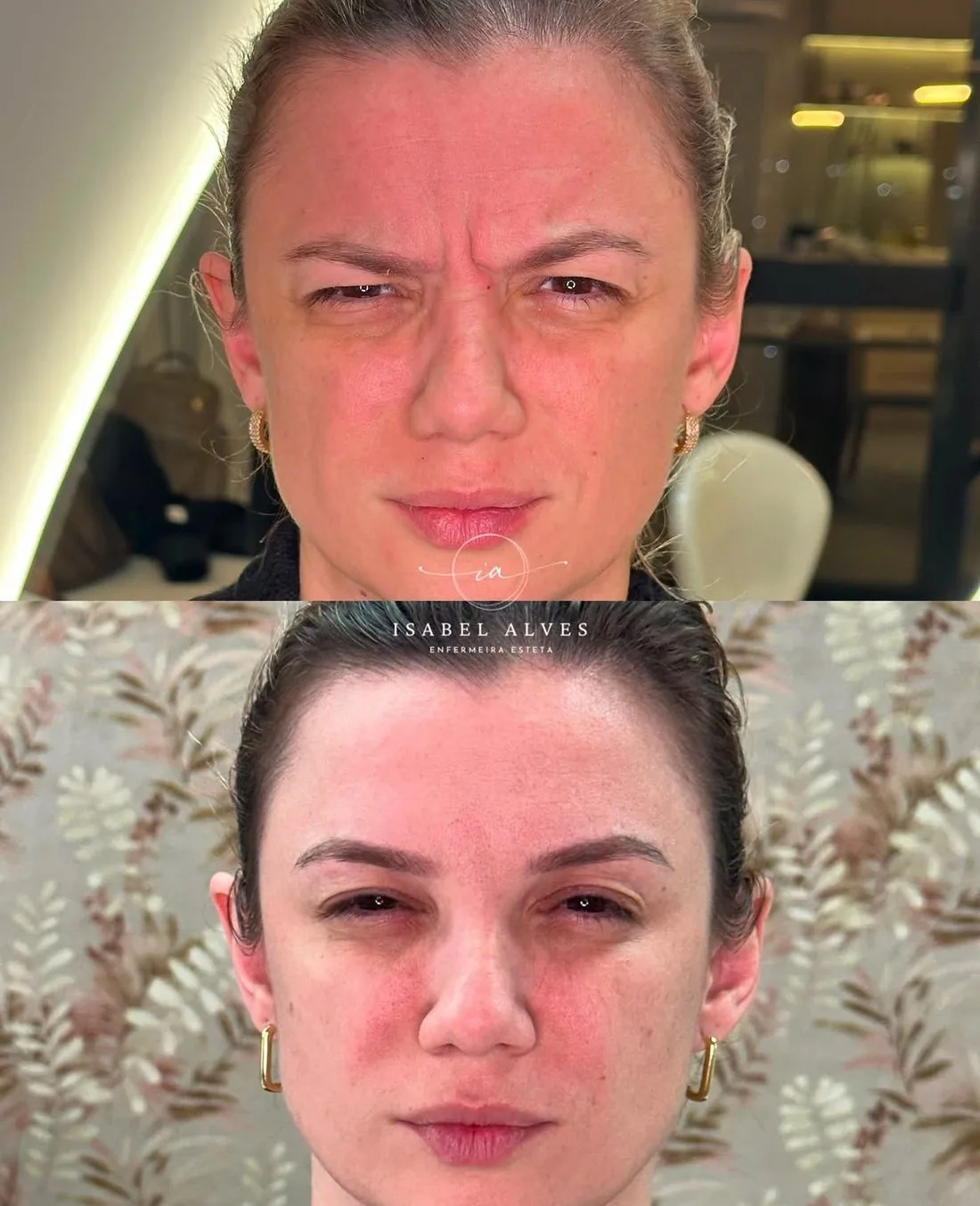 Paciente antes e depois da toxina botulínica: no antes as linhas da glabela aparecem marcadas, no depois a região está lisa.